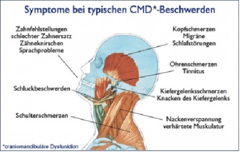 Kiefergelenktherapie/ Craniomandibuläre Dysfunktion (CMD) – Dr. Markus Esch